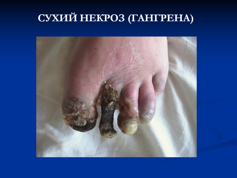 СУХИЙ НЕКРОЗ (ГАНГРЕНА) СУХИЙ НЕКРОЗ (ГАНГРЕНА)